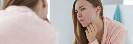 Adult Acne; A Complex That Impacts Your Self-Confidence